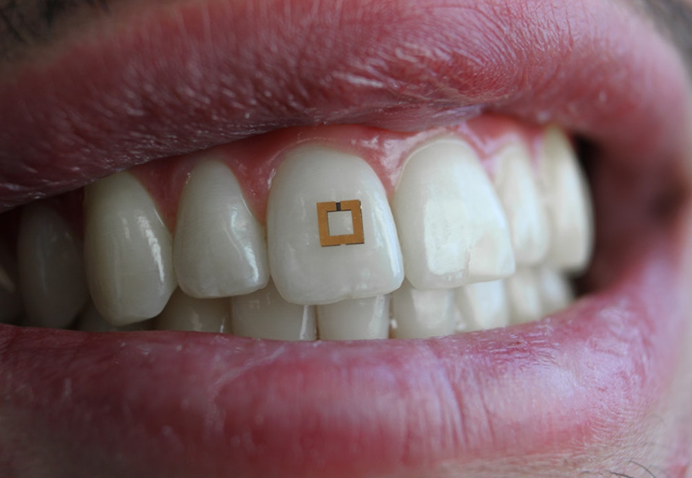Sensor på tanden håller koll på vad du äter