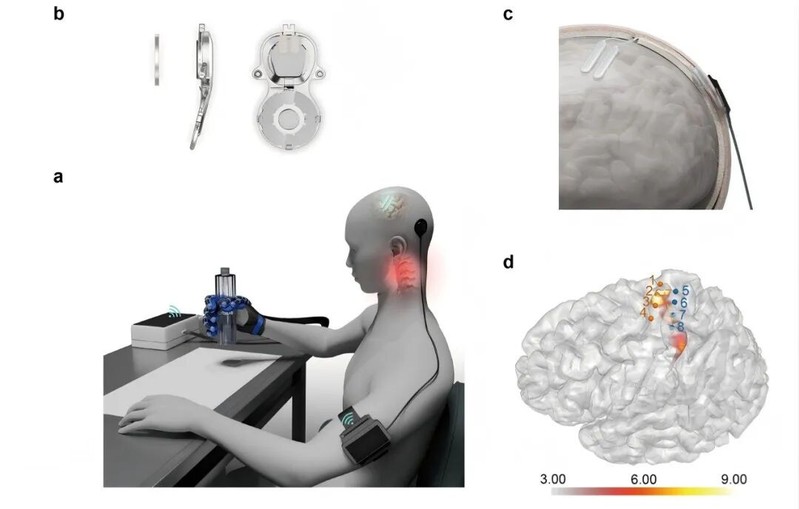 Kina först i världen att godkänna hjärnimplantat mot förlamning